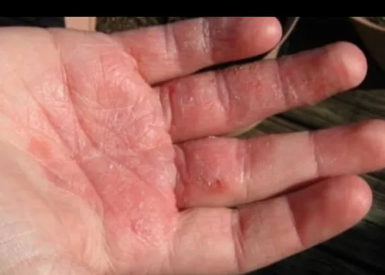 Dermatitis por contacto: que hacer?