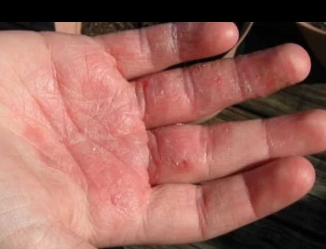 Dermatitis por contacto: que hacer?